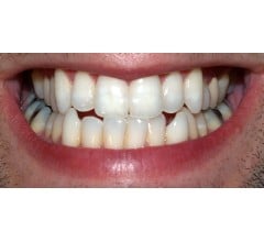 Image for Dental Whitening Strips May Be Damaging Your Teeth