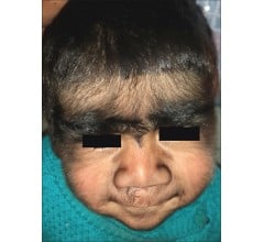Image for Drug Mistake Causes “Werewolf Syndrome” In 17 Children