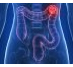 Image for Can Prolonged Antibiotic Use Lead to Colon Cancer?