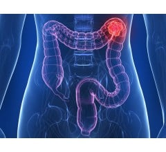 Image for Can Prolonged Antibiotic Use Lead to Colon Cancer?