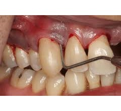 Image for Gum Disease Not Linked To Heart Disease
