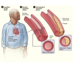 Image for FDA Approves Heart Pump