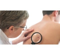 Image for Skin Cancer Named the Most Expensive Cancer